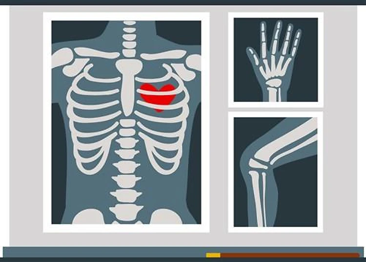 Heart X-Ray